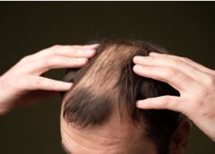 What Causes A Bald Patch?